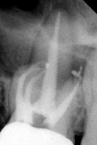 x-ray of my freshly root canalled tooth